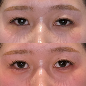 涙袋ヒアルロン酸症例写真　名古屋フィラーの名医の症例写真