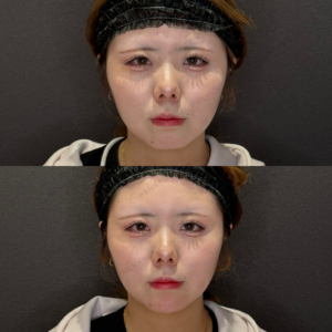 顎ヒアルロン酸症例写真｜レナトゥスクリニック　名古屋名駅で上手い安いヒアルロン酸の症例写真