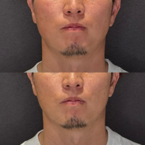 ほうれい線ヒアルロン酸症例写真　レナトゥスクリニック　名古屋で上手い安いヒアルロン酸の症例写真