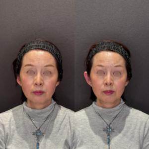 目の上ヒアルロン酸症例写真｜レナトゥスクリニック　名古屋フィラーの名医の症例写真