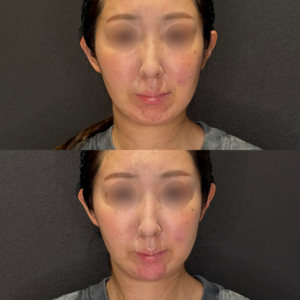 顎ヒアルロン酸症例写真　レナトゥスクリニック　名古屋名駅上手い安いヒアルロン酸の症例写真