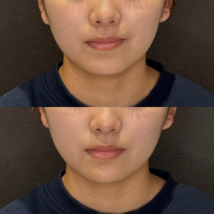 顎ヒアルロン酸症例写真　レナトゥスクリニック　名古屋で上手いヒアル治療の症例写真