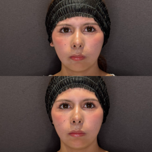 顎ヒアルロン酸症例写真｜レナトゥスクリニック　名古屋名駅直通のヒアルロン酸治療の症例写真