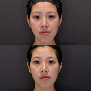 顎ヒアルロン酸症例写真　名古屋名駅で上手い安いヒアル治療の症例写真