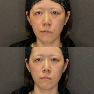 ほうれい線ヒアルロン酸症例写真の症例写真