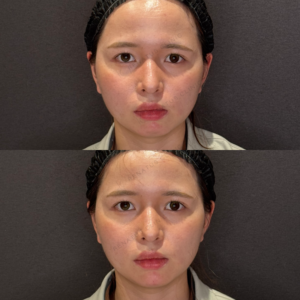 顎ヒアルロン酸症例写真｜レナトゥスクリニック　名古屋で上手い安いフィラー治療の症例写真