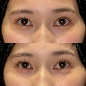 涙袋ヒアルロン酸症例写真　レナトゥスクリニック名古屋院　名駅直通の高品質フィラー治療。の症例写真