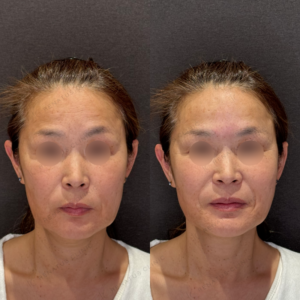 【縦ジワ改善】眉間ヒアルロン酸症例写真　レナトゥスクリニック名古屋院の症例写真