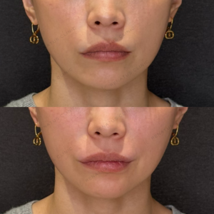 唇ヒアルロン酸症例写真｜レナトゥスクリニック　名古屋名駅ヒアルの名医の症例写真