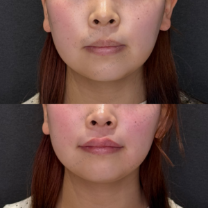 唇ヒアルロン酸症例写真｜レナトゥスクリニック　名古屋名駅ヒアルの名医の症例写真