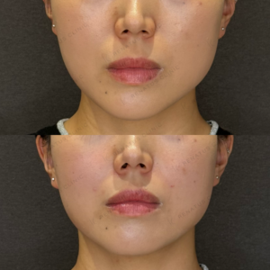 ほうれい線ヒアルロン酸症例写真｜レナトゥスクリニック　名古屋名駅で上手いヒアルロン酸治療の症例写真