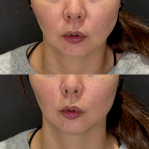 ほうれい線ヒアルロン酸症例写真　名古屋名駅ヒアルの名医の症例写真