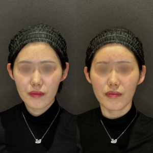 額ヒアルロン酸症例写真　レナトゥスクリニック　名古屋名駅のヒアル治療の症例写真