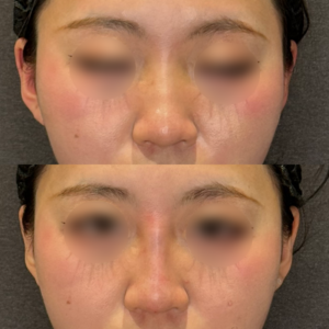 鼻ヒアルロン酸症例写真｜レナトゥスクリニック　名古屋で有名なヒアルロン酸治療の症例写真