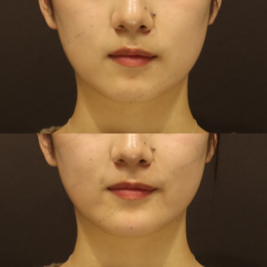 顎ヒアルロン酸症例写真｜レナトゥスクリニック　東京新宿フィラーの名医の症例写真