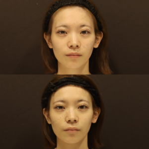 ほうれい線ヒアルロン酸症例写真　レナトゥスクリニック　新宿で上手い安いヒアルロン酸の症例写真