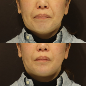 顎ヒアルロン酸症例写真　レナトゥスクリニック　新宿で上手い安いヒアル治療の症例写真