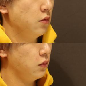 ほうれい線ヒアルロン酸症例写真｜レナトゥスクリニック　新宿で上手い安いヒアルロン酸の症例写真