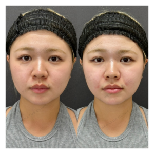 鼻翼基部・ほうれい線・顎ヒアルロン酸ボリューマ・ボリフト症例写真の症例写真