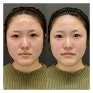 唇ヒアルロン酸ボルベラ症例写真の症例写真