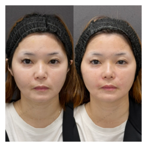 鼻翼基部・ほうれい線ヒアルロン酸ボリューマ症例写真の症例写真