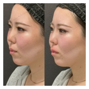 唇ヒアルロン酸ボルベラ症例写真の症例写真