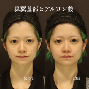 鼻翼基部ヒアルロン酸症例写真の症例写真