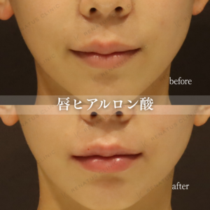 東京で唇ヒアルロン酸が上手いクリニック|レナトゥスクリニック新宿院の症例写真