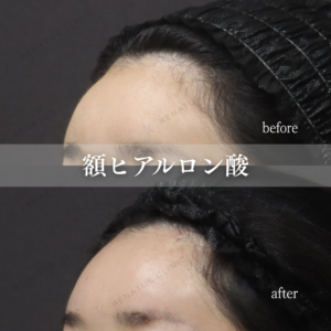 額ヒアルロン酸症例写真|東京新宿で額ヒアルロン酸が上手いクリニックの症例写真