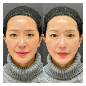 頬・ほうれい線ヒアルロン酸ボリフト症例写真の症例写真