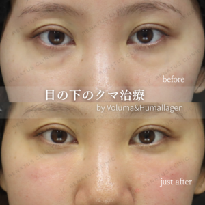 ベビーコラーゲン症例写真。ベビーコラーゲンが東京で安いのに美味い_レナトゥスクリニックの症例写真