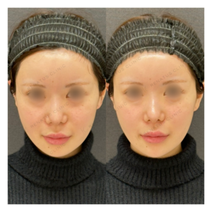 顎ヒアルロン酸症例写真の症例写真