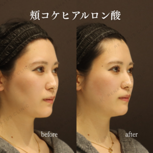 頬コケヒアルロン酸症例写真|新宿頬コケヒアルロン酸の名医の症例写真