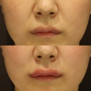 唇ヒアルロン酸ボルベラ症例写真の症例写真