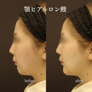 新宿のヒアルロン酸注射（顎）が上手い｜ボラックスで整えた30代女性の顎形成の症例写真