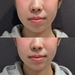顎ヒアルロン酸ボラックス症例写真の症例写真