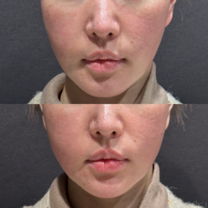 東京田町のヒアルロン酸注射が上手い｜40代女性・ボリフトで頬のボリュームアップの症例写真