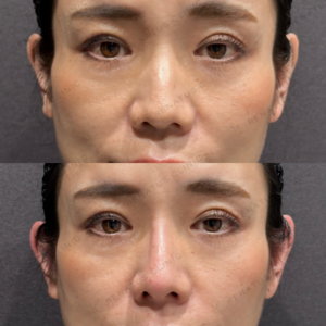 東京田町で鼻ヒアルロン酸が上手いクリニック｜ボラックス使用・40代女性の症例写真