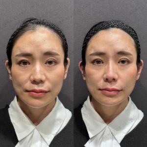 東京田町の立ち耳修正が上手いクリニック｜ボリフト使用・40代女性の症例写真