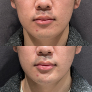 東京田町のヒアルロン酸顎形成が上手い｜20代男性・ボラックス使用の症例写真