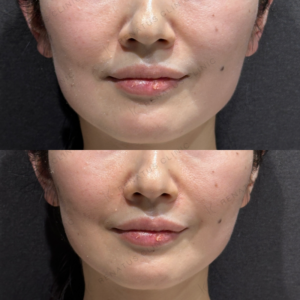 東京田町の鼻翼基部ヒアルロン酸が上手い｜ボリフトで自然な小鼻に整えた40代女性の記録の症例写真