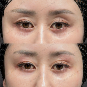 東京田町の目の上ヒアルロン酸が上手い｜ボルベラ使用・40代女性の症例写真