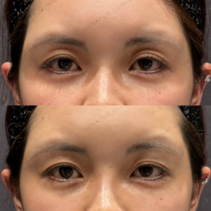 東京田町の目の上ヒアルロン酸が上手い｜ボルベラで自然に若返る20代女性の実例の症例写真