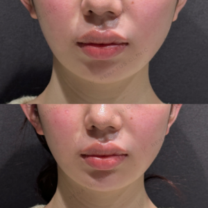 東京田町の顎ヒアルロン酸注射が上手い｜20代女性・ボラックス使用の症例写真