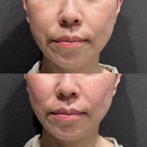 東京田町のゴルゴラインヒアルロン酸が上手い｜40代女性ボリューマ症例の症例写真