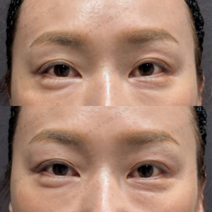 東京田町の目の上ヒアルロン酸注入が上手い｜40代女性・ボルベラ施術の症例写真