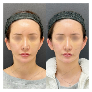 福岡天神の立ち耳修正で上手いと評判｜ボリューマ使用・20代女性の施術の症例写真