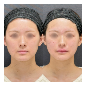 福岡天神のヒアルロン酸注射が上手い｜20代女性・ボリフト・ボルベラで頬・唇・口角を自然に形成の症例写真