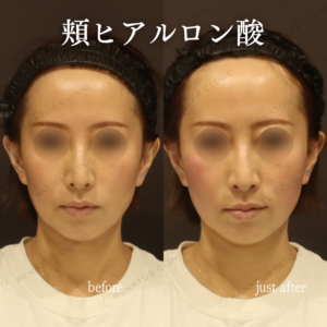新宿のヒアルロン酸注射が上手い｜ボリューマで頬を自然にリフトアップ【40代女性】の症例写真