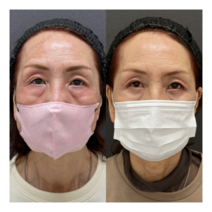 福岡天神の目の下のクマ取り｜自然な若返り（60代女性）の症例写真